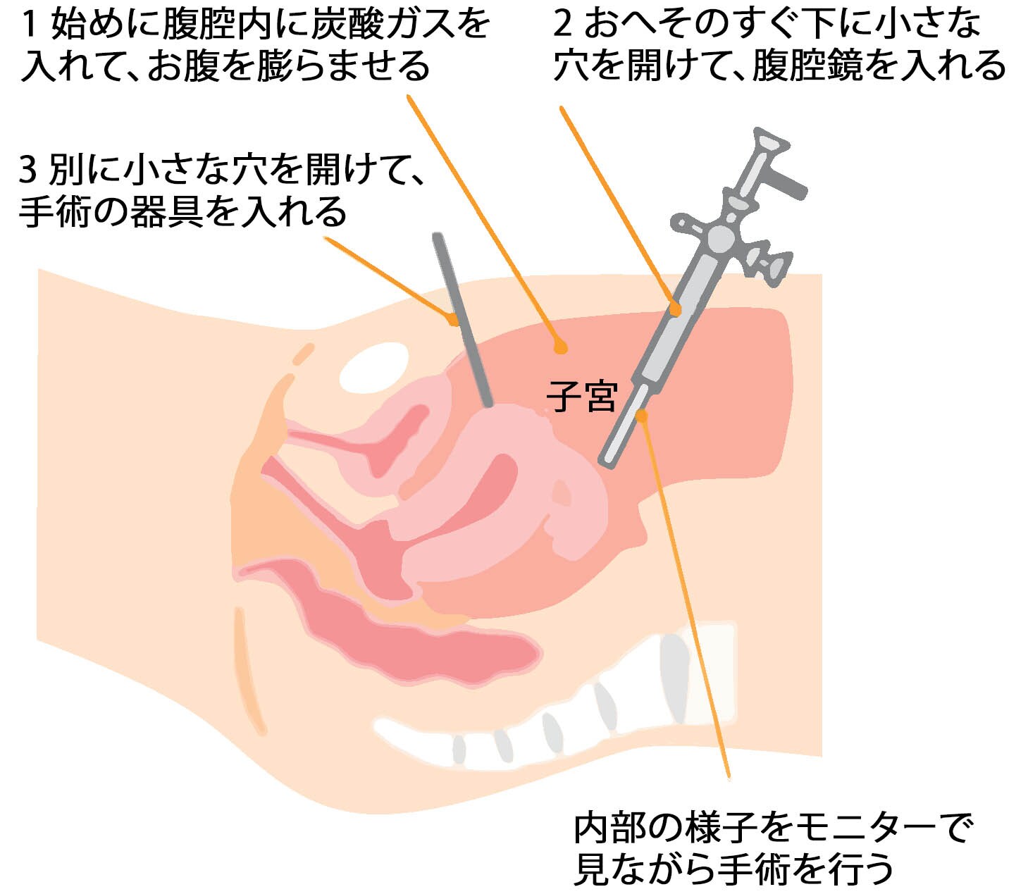 腹腔鏡下手術(イメージ画像)