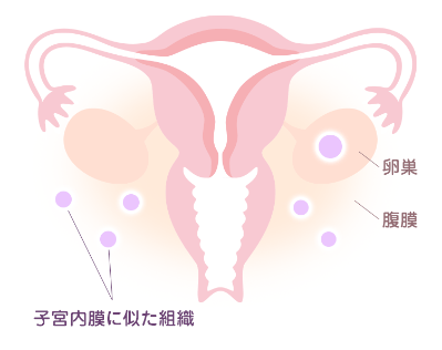 子宮腺筋症