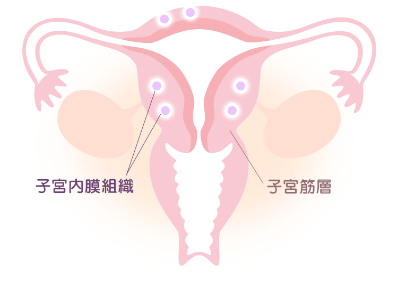 子宮筋腫