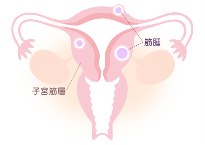 子宮筋腫