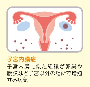 月経困難症の原因として多い「子宮内膜症」