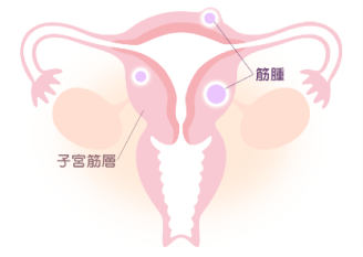 子宮筋腫