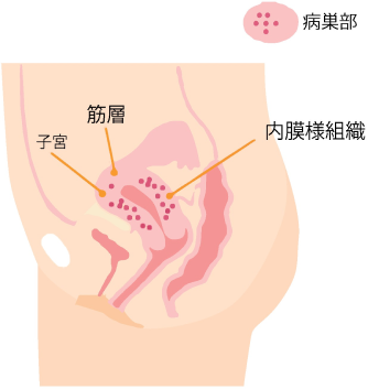 子宮腺筋症