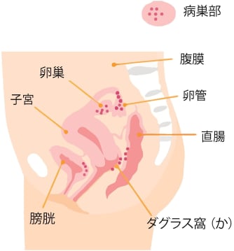 子宮内膜症って、どんな病気なの?