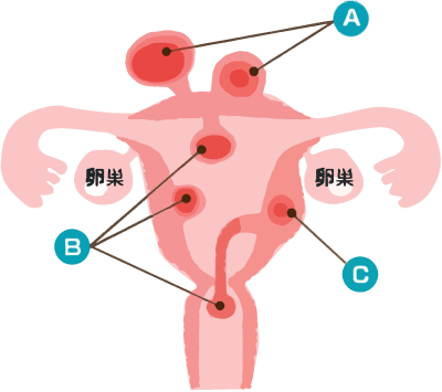 子宮筋腫の種類