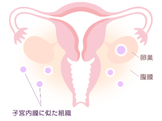 子宮内膜症