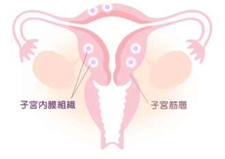 子宮腺筋症