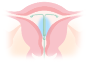 女性ホルモン薬