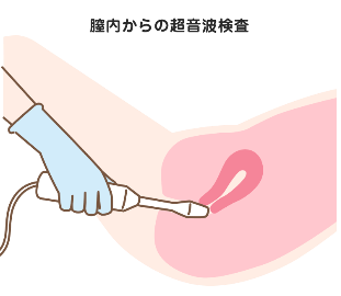 Point:受診のハードルをあげている原因、「内診」について