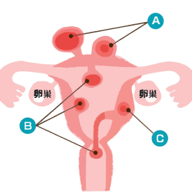 子宮筋腫