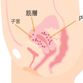 子宮腺筋症